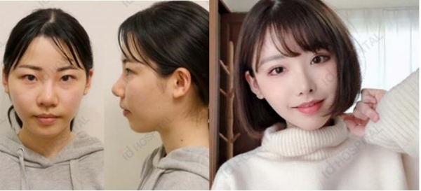 [피플] 일본 유명 배우 후카다 에이미, 한국에서 성형수술 받은 후 인생역전?