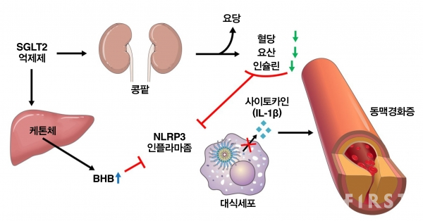 SGLT2 억제제는 콩팥을 통해 요당을 배출하도록 도와 혈액 내 포도당과 요산, 인슐린 수치를 낮춰 NLRP3 인플라마좀 활성을 억제한다. SGLT2 억제제는 또, 간에서 케톤체를 생성해 혈액 내 β-하이드록시부티르산(BHB)을 증가시켜 NLRP3 인플라마좀을 억제하는 것으로 이번 연구에서 밝혀졌다. 억제된 NLRP3은 대식세포내 사이토카인의 생산을 줄이는 것으로 확인됐다. 사이토카인은 죽상동맥경화증을 유발한다. (사진=세브란스)