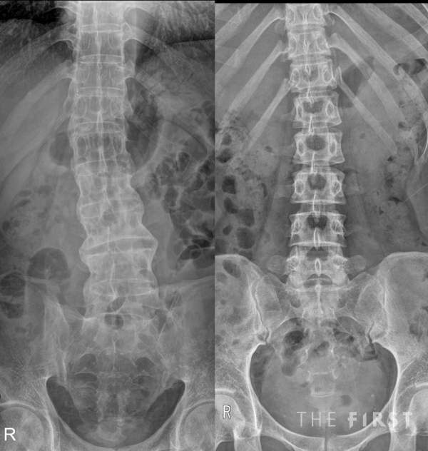 강직성 척추염(왼쪽)은 정상 척추(오른쪽)보다 관절 없이 하나의 긴 뼈처럼 이어진 모습을 빗대 ‘대나무 척추(bamboo spine)’라고 부른다. (사진=인천성모병원 제공)