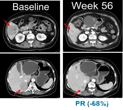 임상 시작 전(Baseline,좌측)과 벨바라페닙 투여 56주 후 흑색종 환자의 복부 CT사진.
