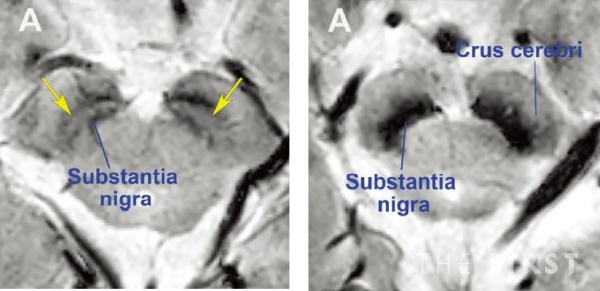 정상 모양의 흑질(좌), 파킨슨병 환자의 흑질(우) MRI 영상. (사진=분당서울대병원 제공)