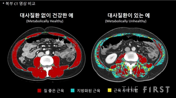 대사질환 없이 건강한 사람과 그렇지 못한 사람의 복부 CT 영상 비교.