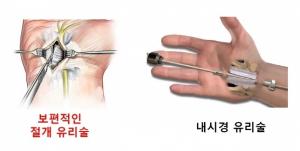 손목터널증후군 손저림 유발 신경손상, 대안으로 제시된 ‘양방향내시경 유리술’은?